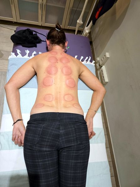 Marques rondes laissées par les ventouses sur le dos